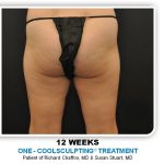 Coolsculpting Before & After Patient #4875