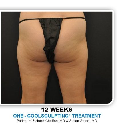 Coolsculpting Before & After Patient #4875