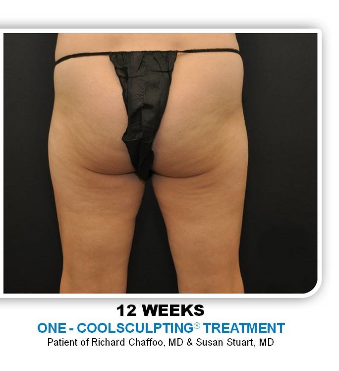 Coolsculpting Before & After Patient #4875