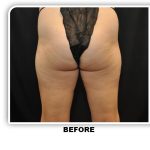 Coolsculpting Before & After Patient #4875