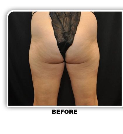 Coolsculpting Before & After Patient #4875
