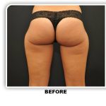 Coolsculpting Before & After Patient #4878