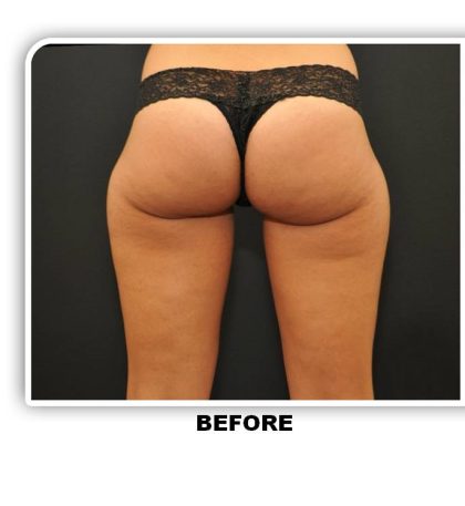 Coolsculpting Before & After Patient #4878