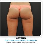 Coolsculpting Before & After Patient #4878