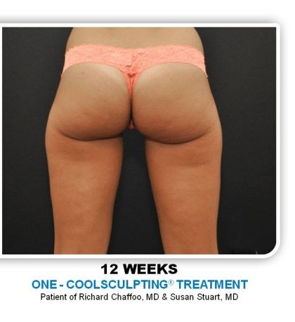 Coolsculpting Before & After Patient #4878