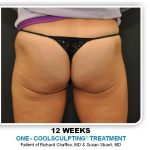 Coolsculpting Before & After Patient #4881