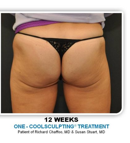 Coolsculpting Before & After Patient #4881