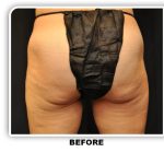 Coolsculpting Before & After Patient #4881