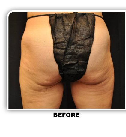 Coolsculpting Before & After Patient #4881