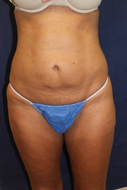 Liposuction Before & After Patient #4998