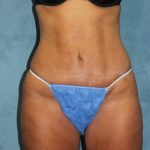 Liposuction Before & After Patient #4998