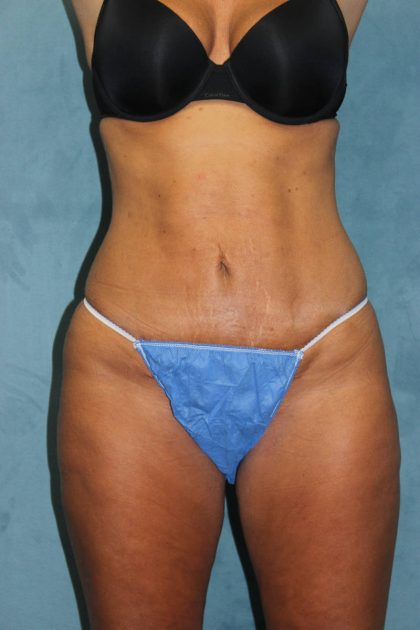 Liposuction Before & After Patient #4998