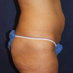 Liposuction Before & After Patient #4998