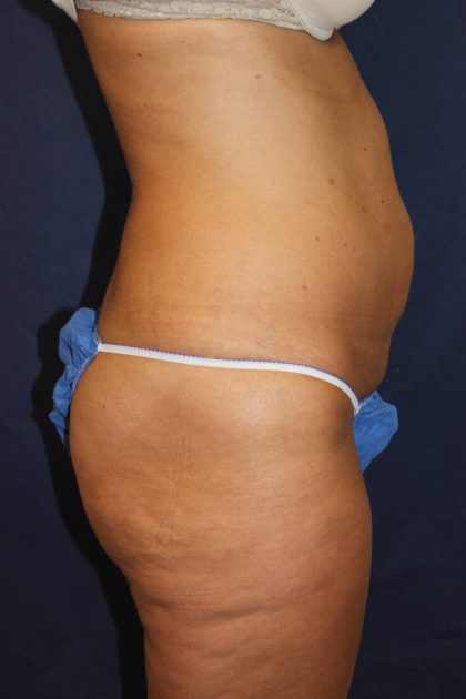 Liposuction Before & After Patient #4998