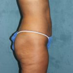 Liposuction Before & After Patient #4998