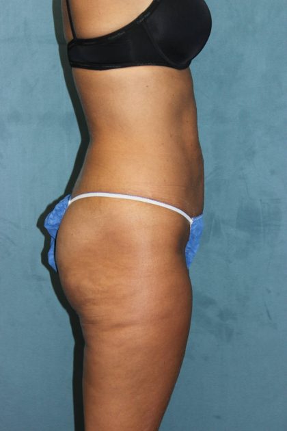 Liposuction Before & After Patient #4998