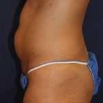 Liposuction Before & After Patient #4998