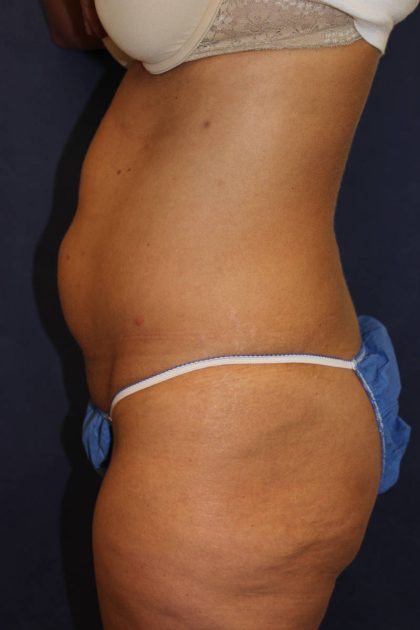 Liposuction Before & After Patient #4998