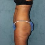 Liposuction Before & After Patient #4998