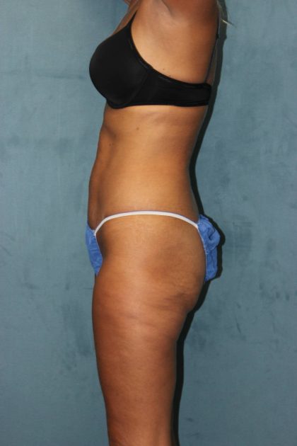 Liposuction Before & After Patient #4998