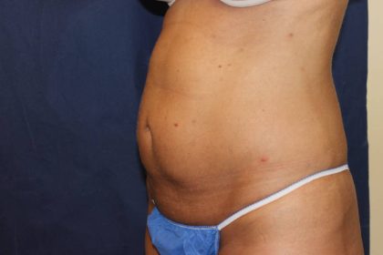 Liposuction Before & After Patient #4998