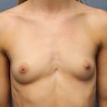 Breast Augmentation Before & After Patient #4964