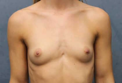 Breast Augmentation Before & After Patient #4964