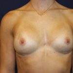 Breast Augmentation Before & After Patient #4964