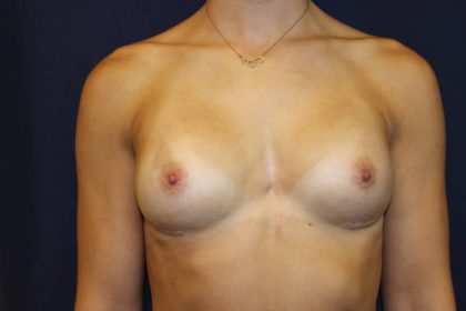 Breast Augmentation Before & After Patient #4964