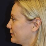 Revision Rhinoplasty Before & After Patient #3872