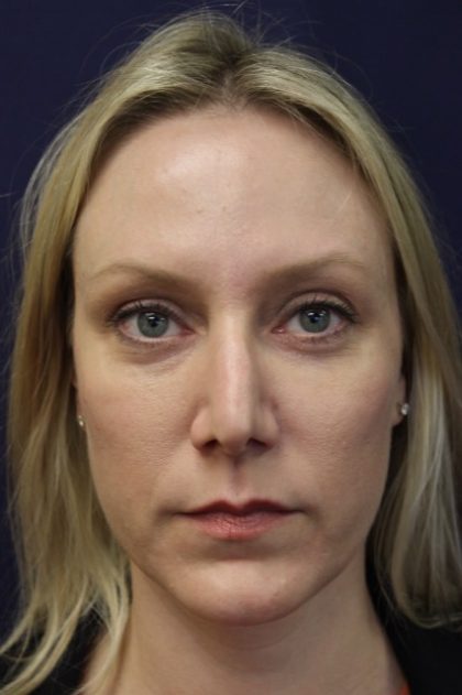 Revision Rhinoplasty Before & After Patient #3872