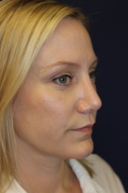 Revision Rhinoplasty Before & After Patient #3872