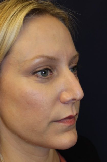 Revision Rhinoplasty Before & After Patient #3872