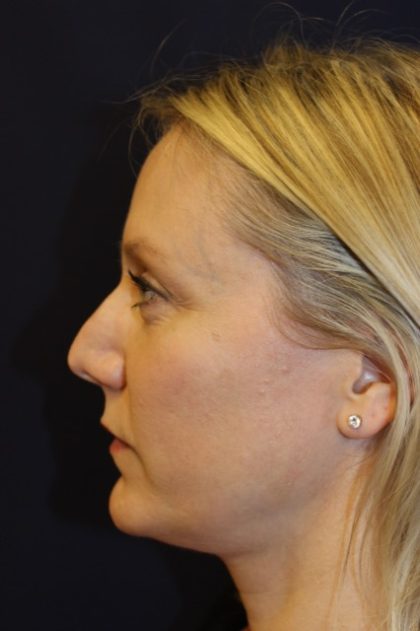 Revision Rhinoplasty Before & After Patient #3872