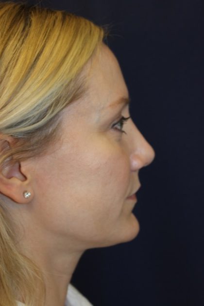 Revision Rhinoplasty Before & After Patient #3872