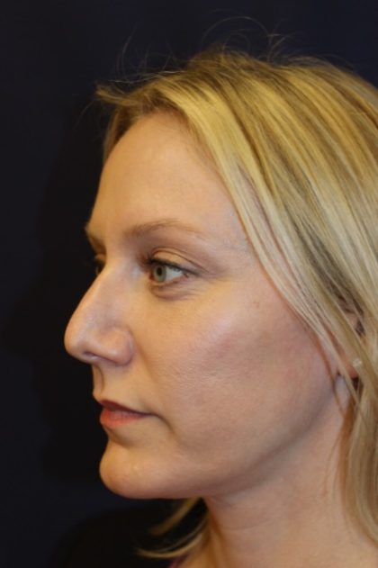 Revision Rhinoplasty Before & After Patient #3872