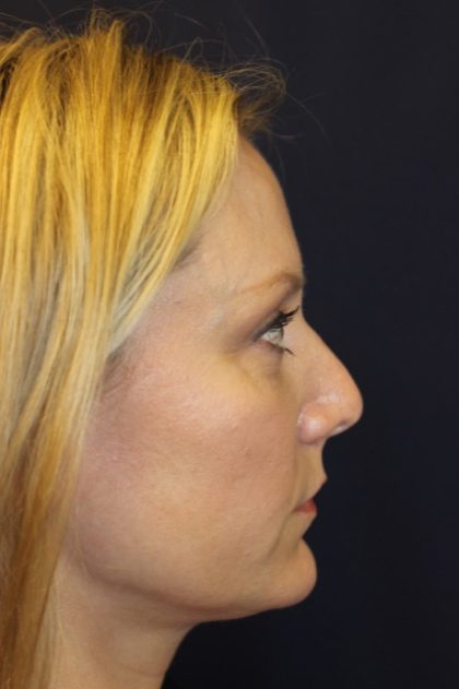 Revision Rhinoplasty Before & After Patient #3872