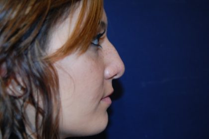 Rhinoplasty Before & After Patient #3663