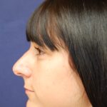 Rhinoplasty Before & After Patient #3658