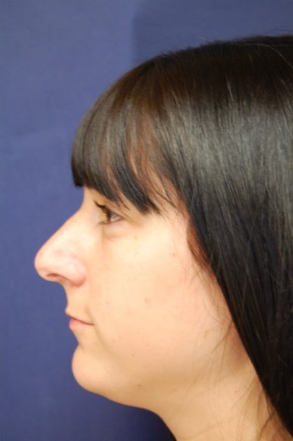 Rhinoplasty Before & After Patient #3658