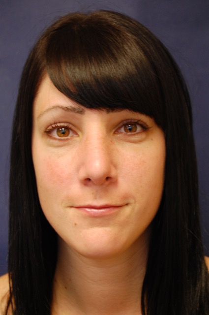 Rhinoplasty Before & After Patient #3658