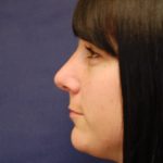 Rhinoplasty Before & After Patient #3658