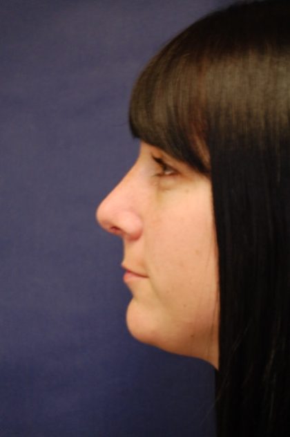 Rhinoplasty Before & After Patient #3658