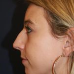 Rhinoplasty Before & After Patient #3909