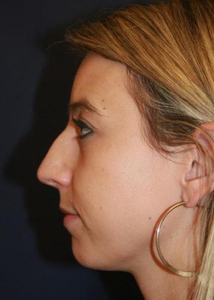 Rhinoplasty Before & After Patient #3909