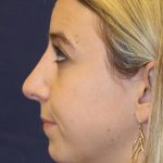 Rhinoplasty Before & After Patient #3909