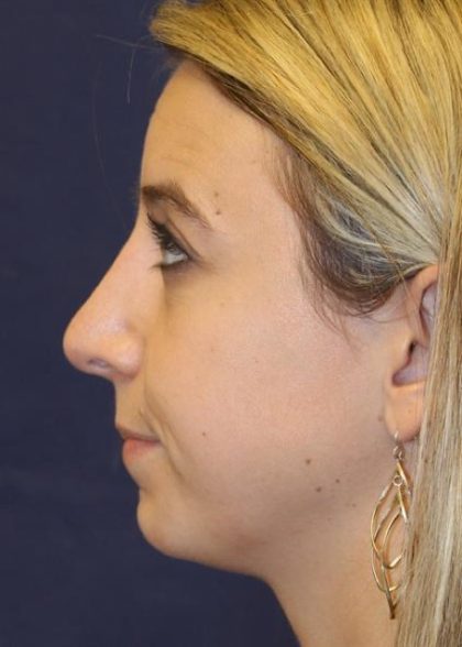 Rhinoplasty Before & After Patient #3909