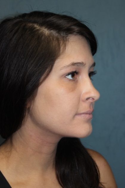 Rhinoplasty Before & After Patient #3943