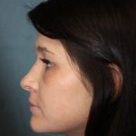 Rhinoplasty Before & After Patient #3943