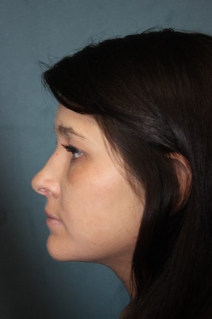 Rhinoplasty Before & After Patient #3943